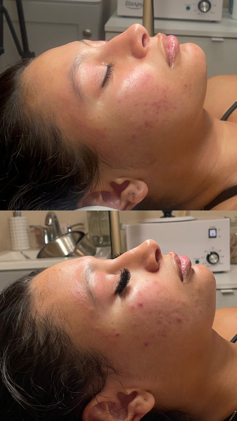 Acne & Hyperpigmentation Facial